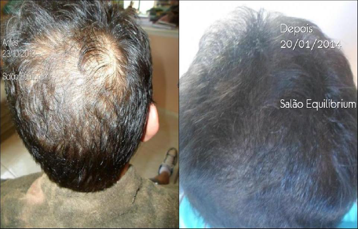 O Urbano Spa age na desobstrução dos poros. Na imagem, um cabelo com 3 meses de tratamento.