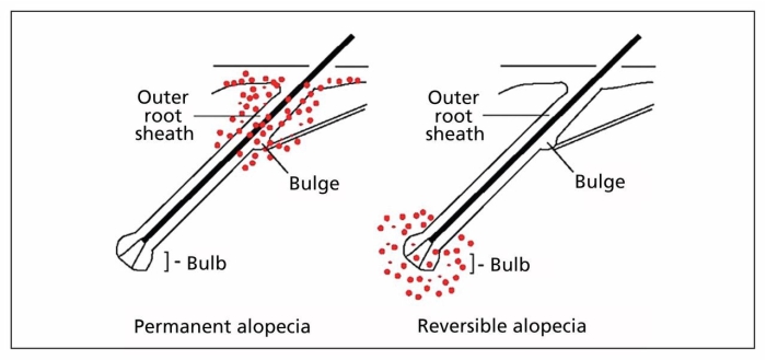 Ilustração da diferença entre alopecia permanente e alopecia reversível.