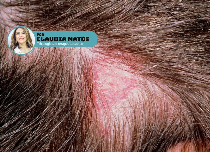 Dermatite seborreica no couro cabeludo.